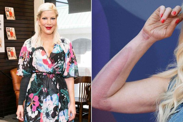 Tori Spelling Says She’s ‘Wearing My Thigh on My Arm’ from Skin Graft After Falling on a Hot Hibachi Grill
